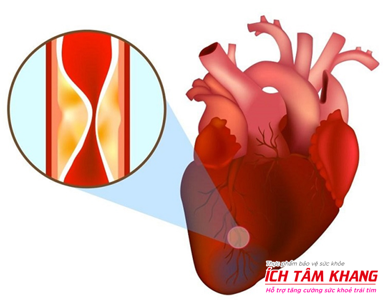 Nhồi máu cơ tim là biến chứng nặng nề ở người thiểu năng vành